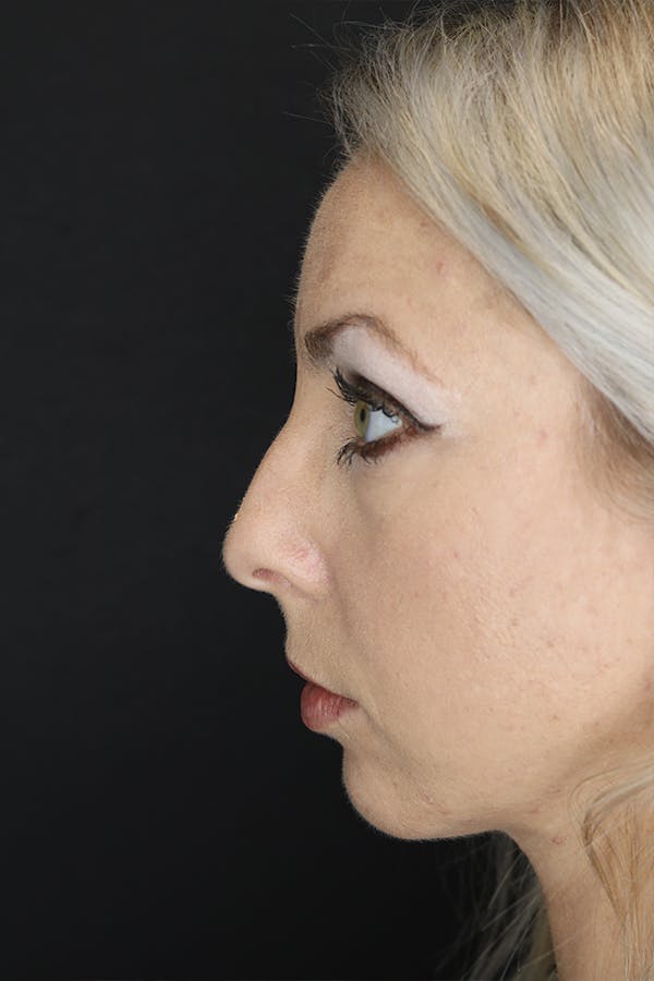 Rhinoplasty Before & After Gallery - Patient 53084380 - Image 5
