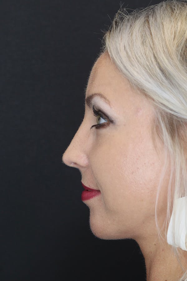 Rhinoplasty Before & After Gallery - Patient 53084380 - Image 6