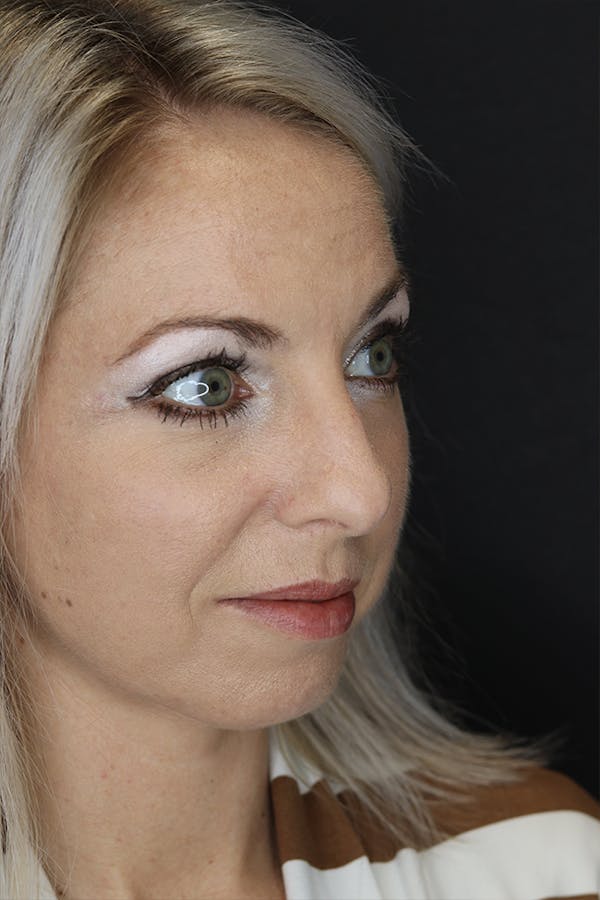 Rhinoplasty Before & After Gallery - Patient 53084380 - Image 7