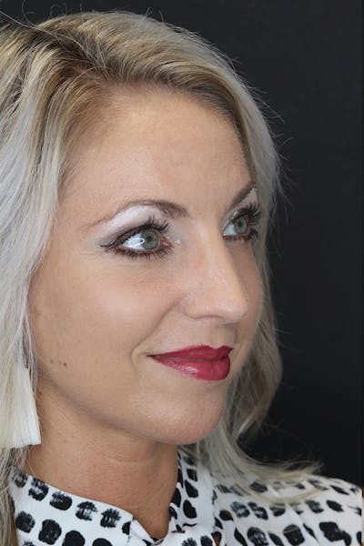 Rhinoplasty Before & After Gallery - Patient 53084380 - Image 8