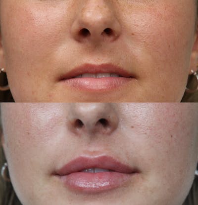 Lip Augmentation Before & After Gallery - Patient 53082296 - Image 1