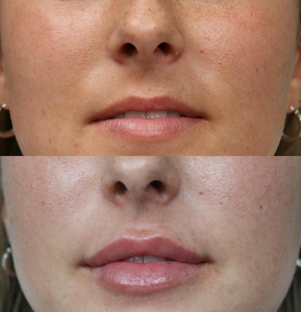 Lip Augmentation Before & After Gallery - Patient 53082296 - Image 1