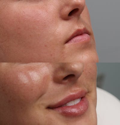 Lip Augmentation Before & After Gallery - Patient 53082296 - Image 2