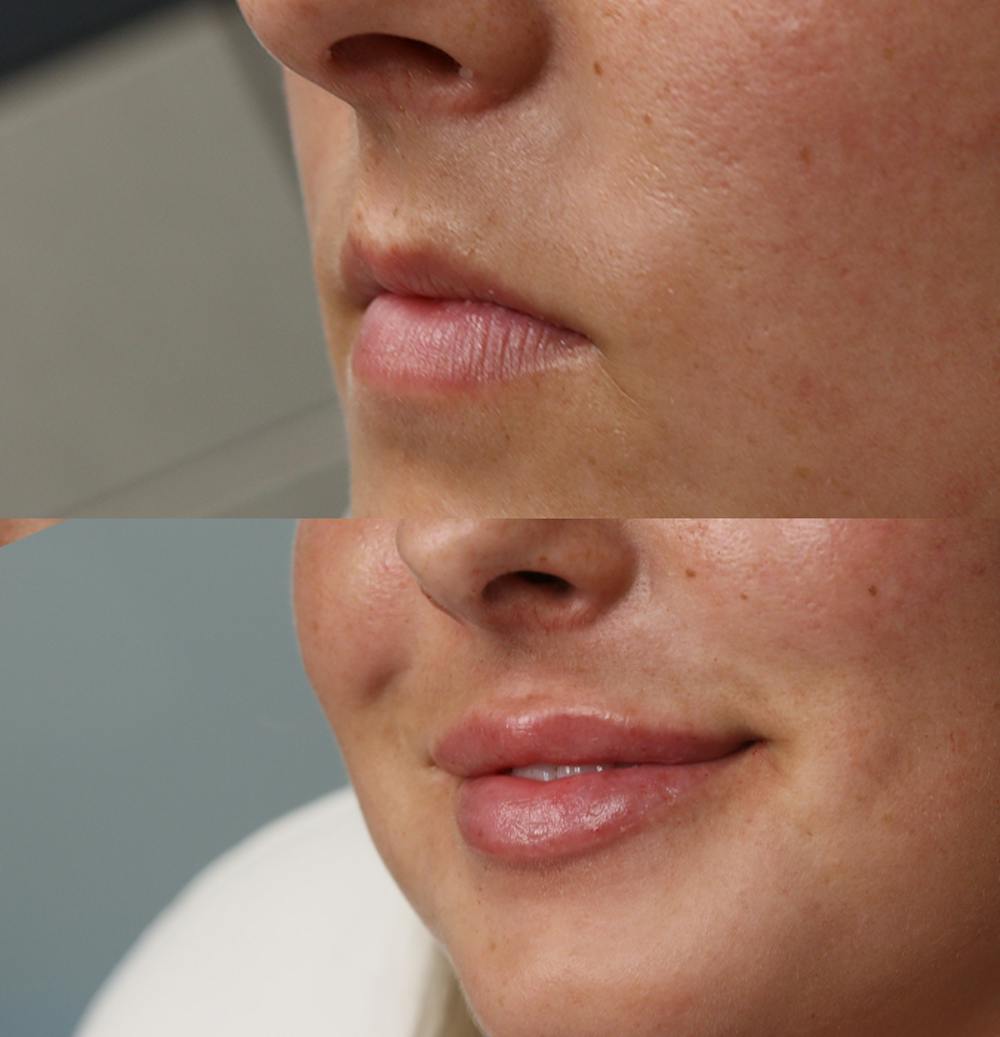Lip Augmentation Before & After Gallery - Patient 53082296 - Image 3