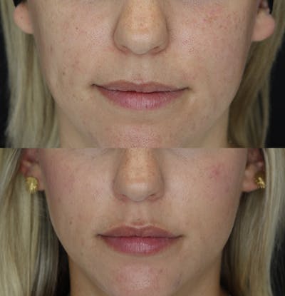 Lip Augmentation Before & After Gallery - Patient 53082297 - Image 1