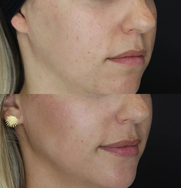 Lip Augmentation Before & After Gallery - Patient 53082297 - Image 2