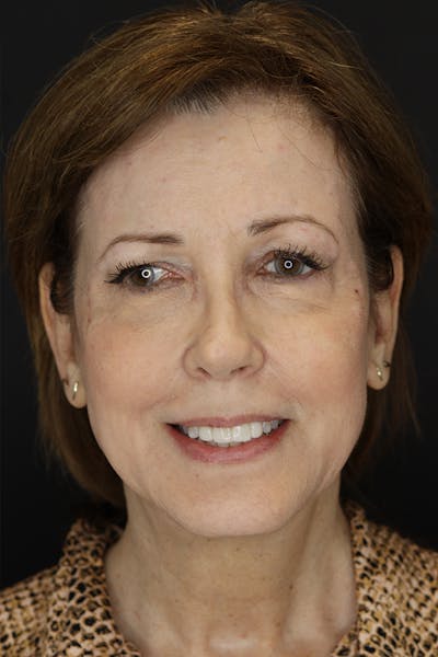 Neuromodulators Before & After Gallery - Patient 53082371 - Image 1