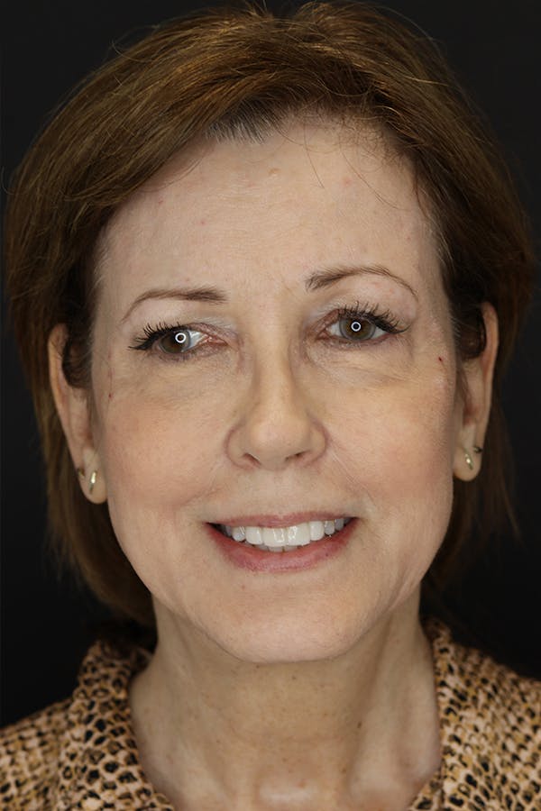 Neuromodulators Before & After Gallery - Patient 53082371 - Image 1