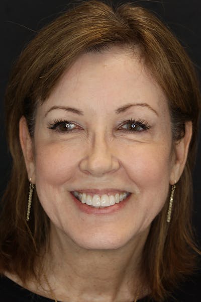 Neuromodulators Before & After Gallery - Patient 53082371 - Image 2