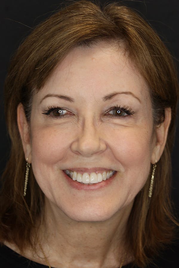 Neuromodulators Before & After Gallery - Patient 53082371 - Image 2