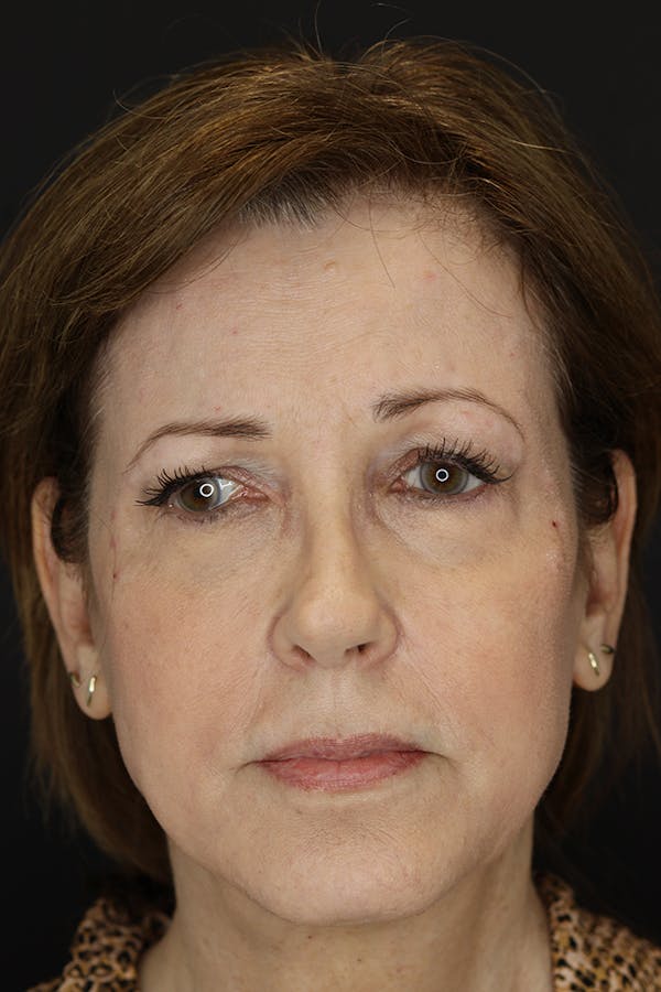 Neuromodulators Before & After Gallery - Patient 53082371 - Image 3