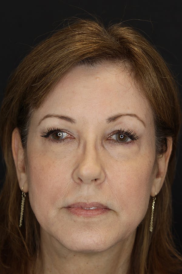 Neuromodulators Before & After Gallery - Patient 53082371 - Image 4