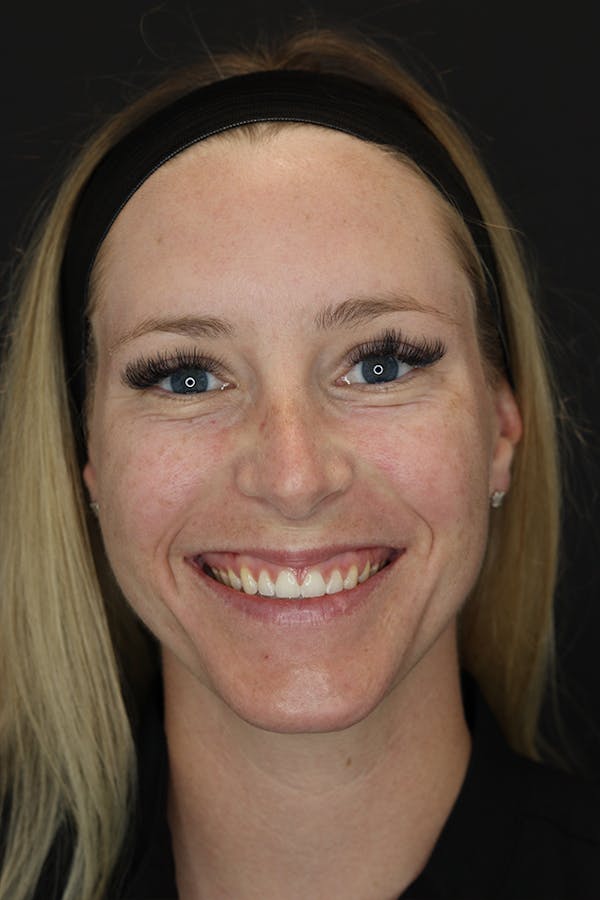 Nonsurgical Rhinoplasty Before & After Gallery - Patient 53082466 - Image 1