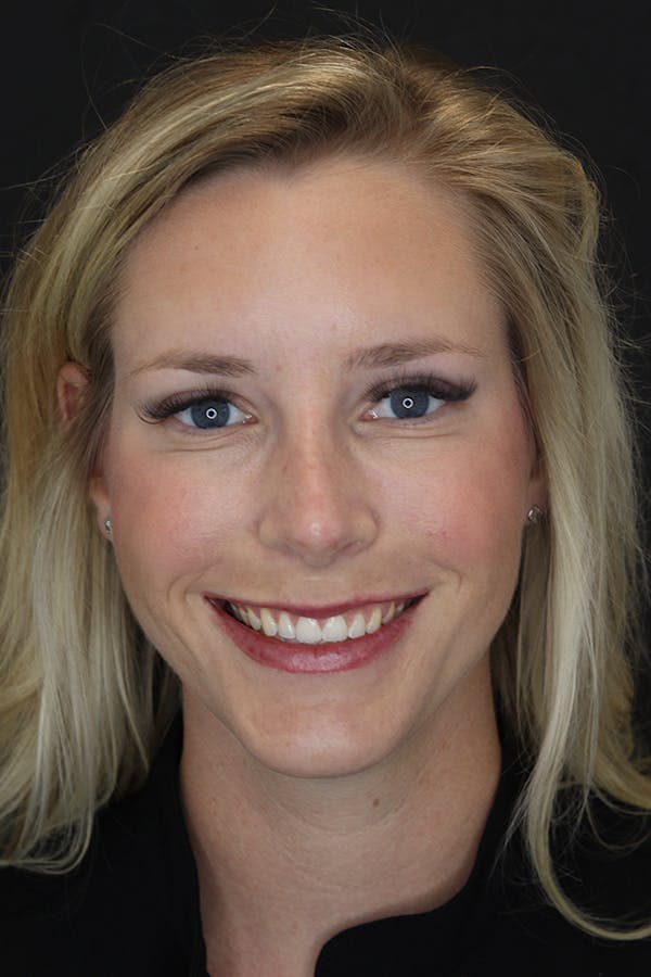 Nonsurgical Rhinoplasty Before & After Gallery - Patient 53082466 - Image 2