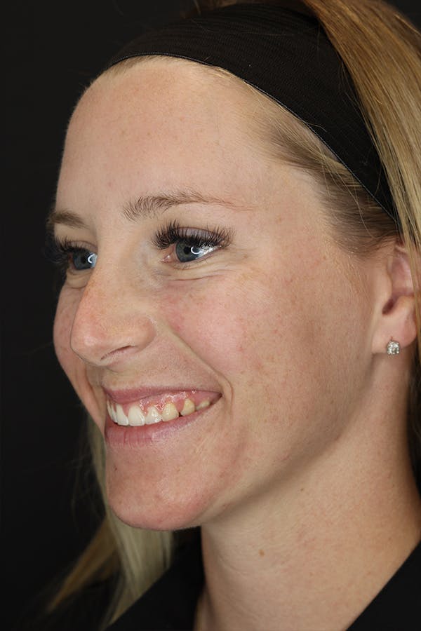 Nonsurgical Rhinoplasty Before & After Gallery - Patient 53082466 - Image 3