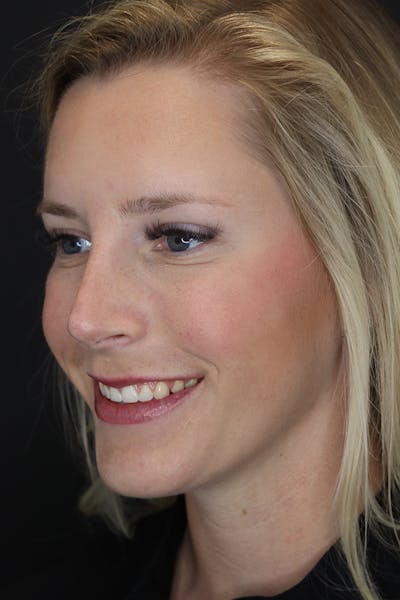 Nonsurgical Rhinoplasty Gallery - Patient 53082466 - Image 4