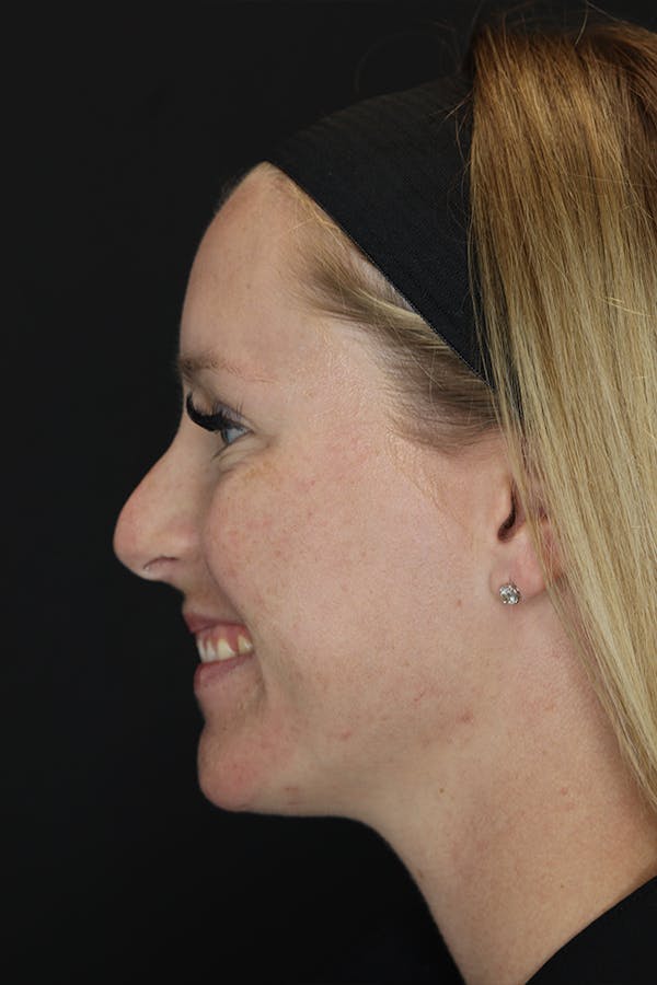Nonsurgical Rhinoplasty Before & After Gallery - Patient 53082466 - Image 5