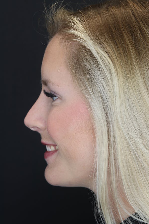 Nonsurgical Rhinoplasty Gallery - Patient 53082466 - Image 6