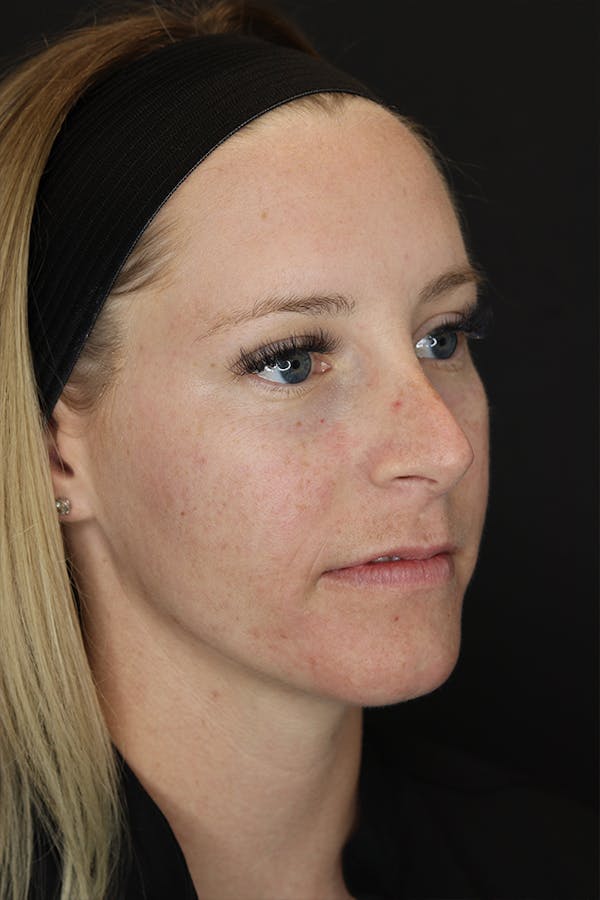 Nonsurgical Rhinoplasty Before & After Gallery - Patient 53082466 - Image 7