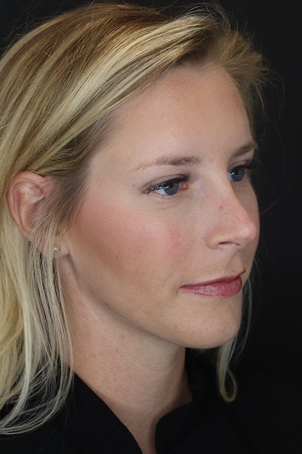 Nonsurgical Rhinoplasty Before & After Gallery - Patient 53082466 - Image 8
