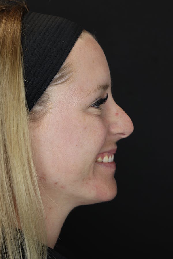 Nonsurgical Rhinoplasty Before & After Gallery - Patient 53082466 - Image 9