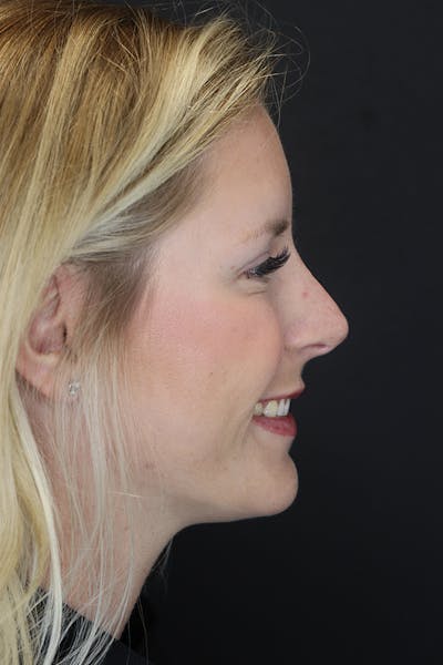Nonsurgical Rhinoplasty Before & After Gallery - Patient 53082466 - Image 10
