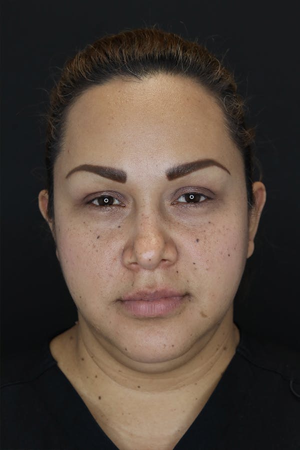 Buccal Fat Removal Before & After Gallery - Patient 53082533 - Image 1