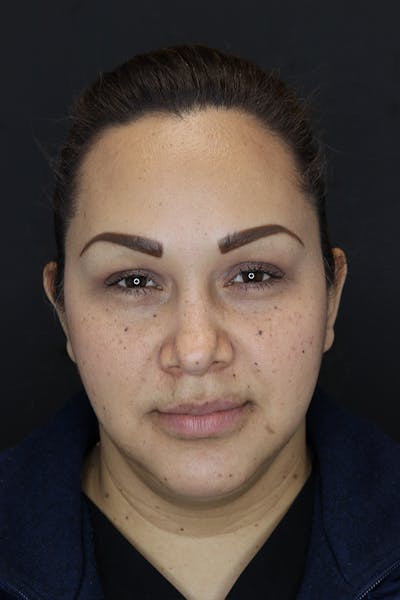 Neck Liposuction Before & After Gallery - Patient 53083948 - Image 2