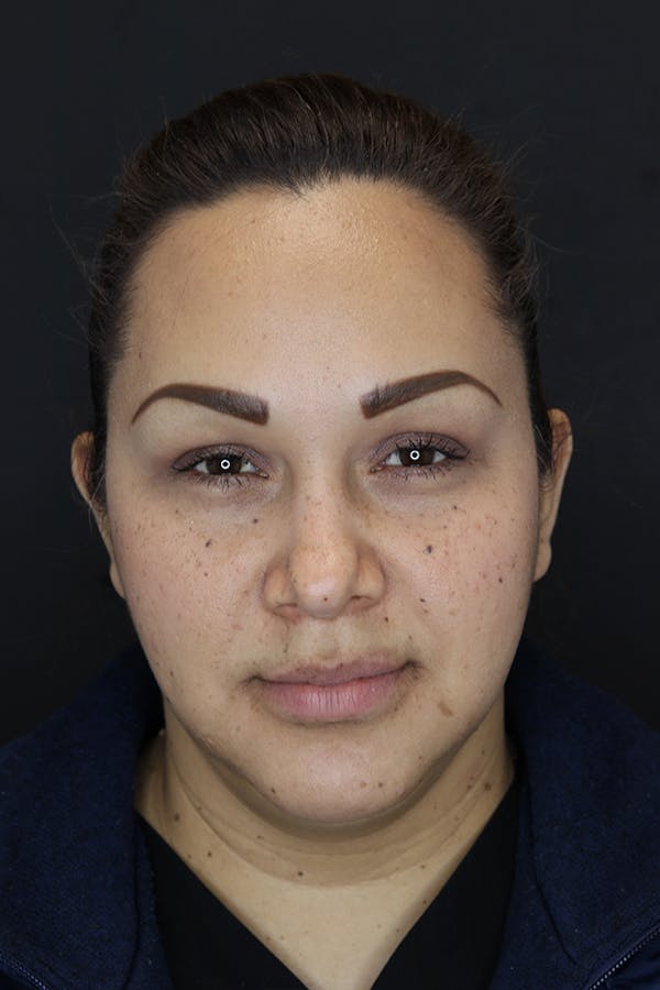 Buccal Fat Removal Before & After Gallery - Patient 53082533 - Image 2