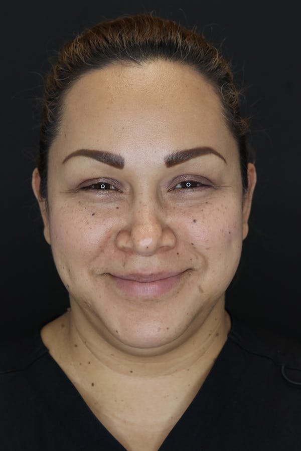 Buccal Fat Removal Before & After Gallery - Patient 53082533 - Image 3