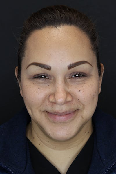 Buccal Fat Removal Before & After Gallery - Patient 53082533 - Image 4