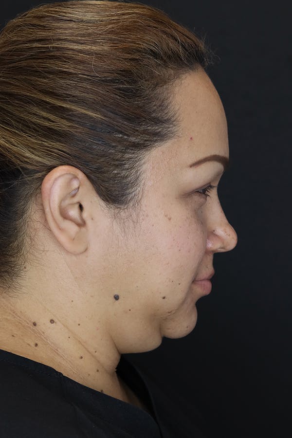 Buccal Fat Removal Before & After Gallery - Patient 53082533 - Image 5