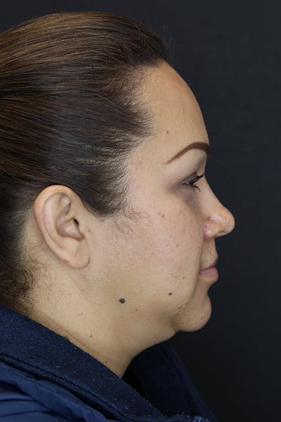Buccal Fat Removal Before & After Gallery - Patient 53082533 - Image 6