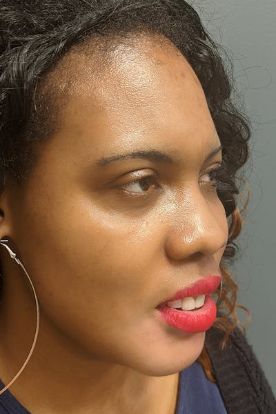 Chin Augmentation  Before & After Gallery - Patient 53082677 - Image 2