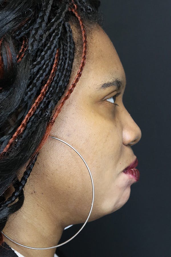 Before and after chin augmentation