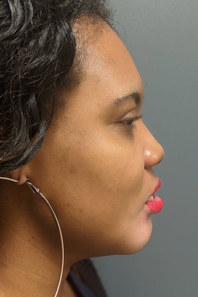 Chin Augmentation  Before & After Gallery - Patient 53082677 - Image 4