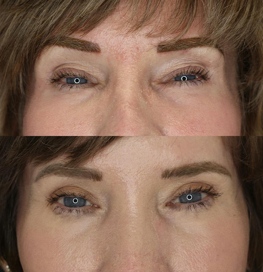 Eyelid Surgery Before & After Gallery - Patient 53082734 - Image 1