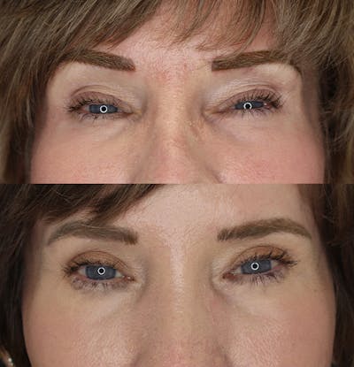 Eyelid Surgery Gallery - Patient 53082734 - Image 1