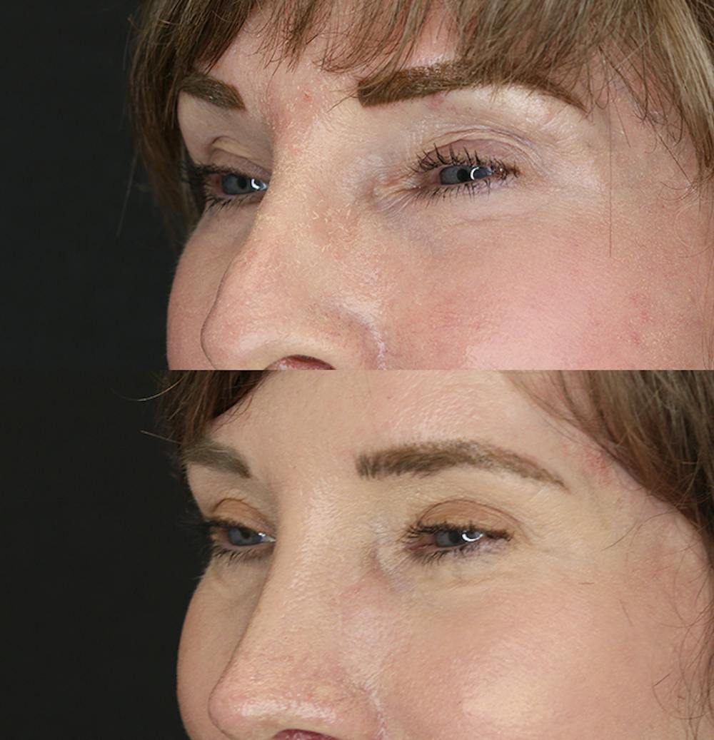 Eyelid Surgery Before & After Gallery - Patient 53082734 - Image 2