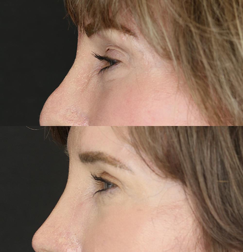 Eyelid Surgery Before & After Gallery - Patient 53082734 - Image 3