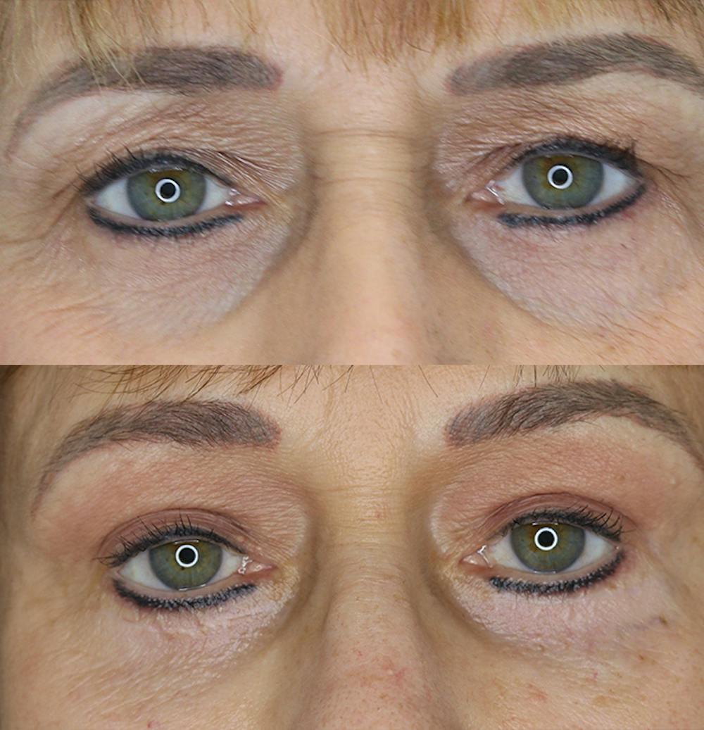 Eyelid Surgery Gallery - Patient 53082735 - Image 1