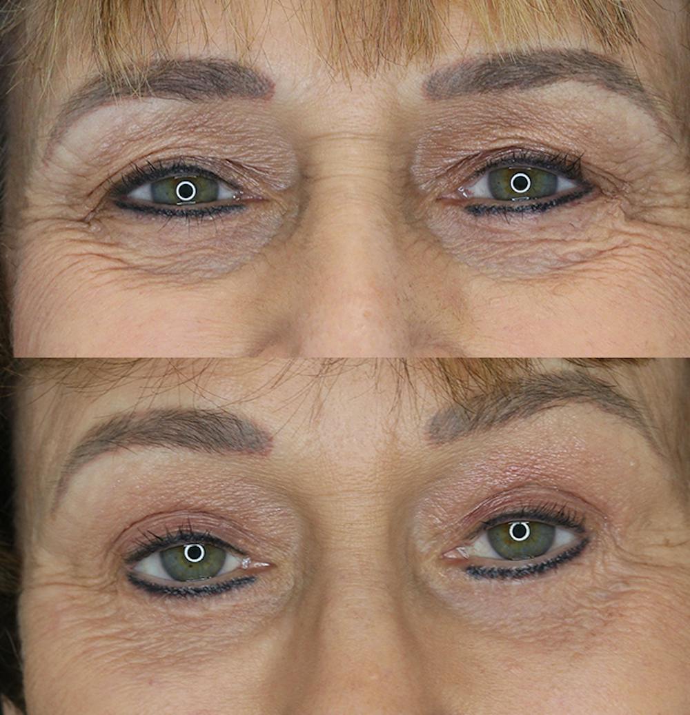 Eyelid Surgery Gallery - Patient 53082735 - Image 2