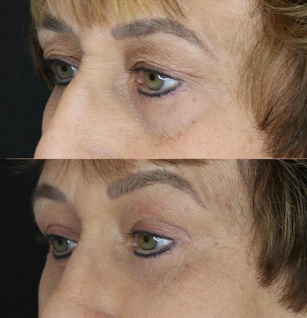 Eyelid Surgery Before & After Gallery - Patient 53082735 - Image 3