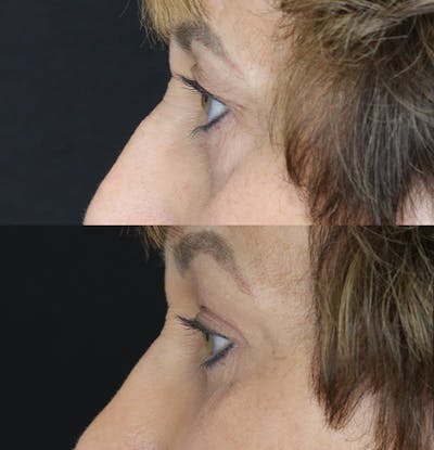 Eyelid Surgery Before & After Gallery - Patient 53082735 - Image 4