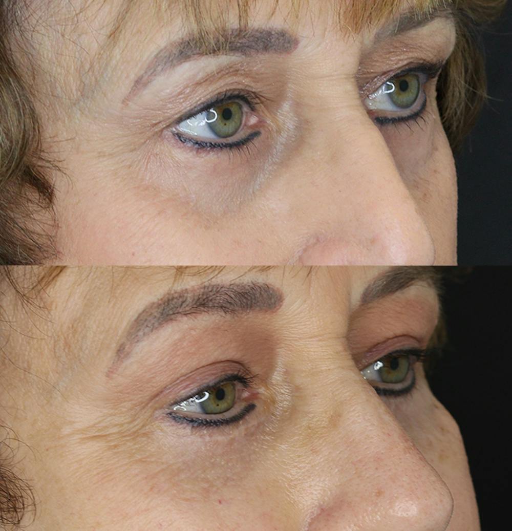 Eyelid Surgery Before & After Gallery - Patient 53082735 - Image 5