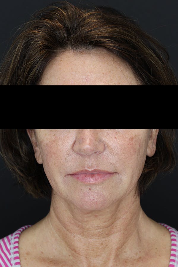 Facelift & Necklift Before & After Gallery - Patient 53083078 - Image 1