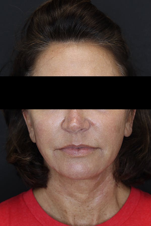 Facelift & Necklift Before & After Gallery - Patient 53083078 - Image 2
