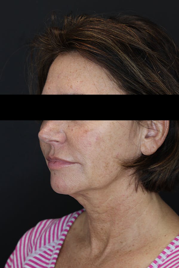 Facelift & Necklift Before & After Gallery - Patient 53083078 - Image 3