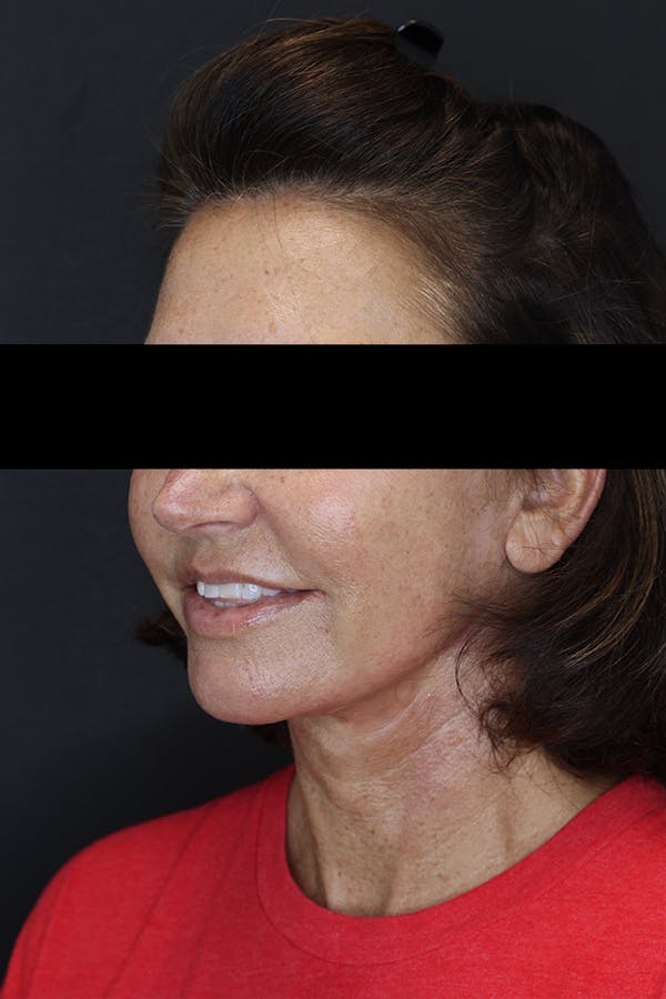 Facelift & Necklift Before & After Gallery - Patient 53083078 - Image 4