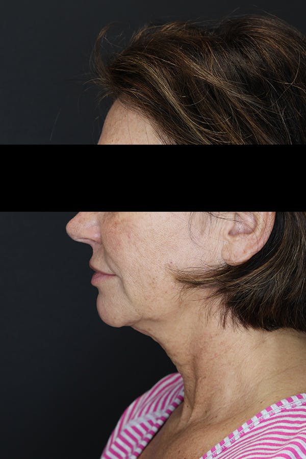 Facelift & Necklift Before & After Gallery - Patient 53083078 - Image 5